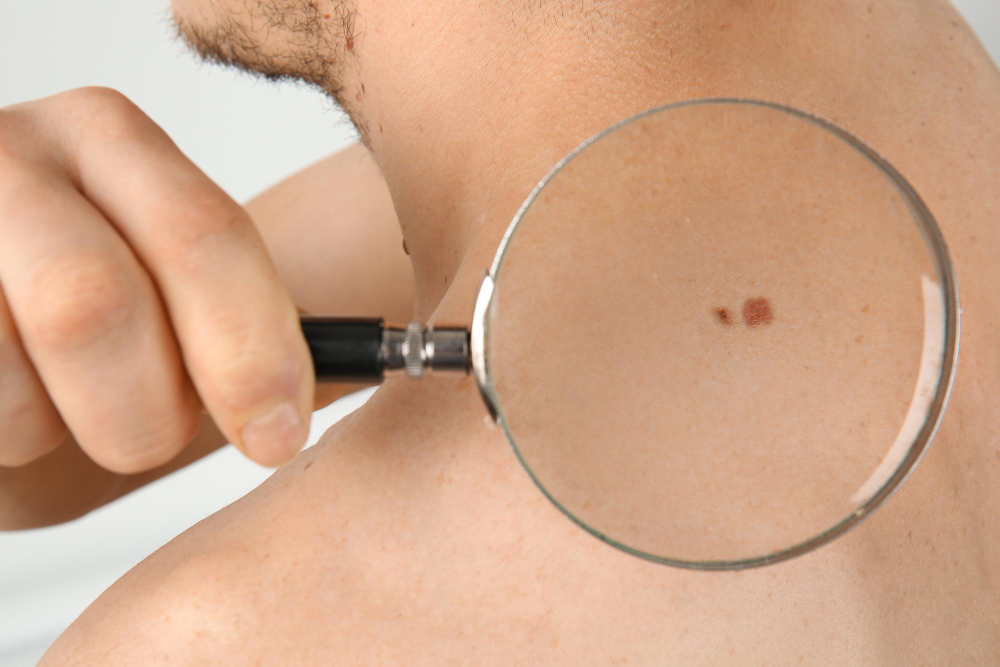 Mole and skin tag removal