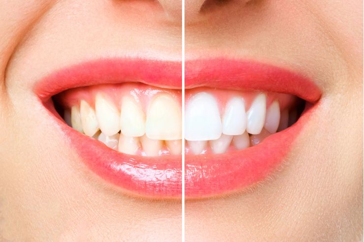 Teeth cleaning and whitening