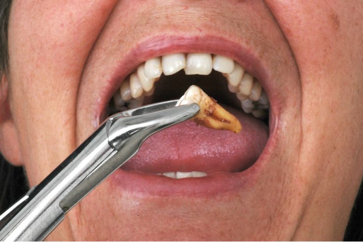 Tooth Extraction